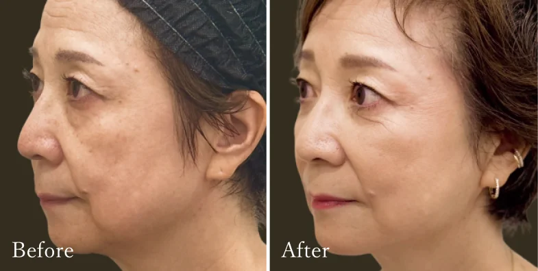 症例2 Before/After