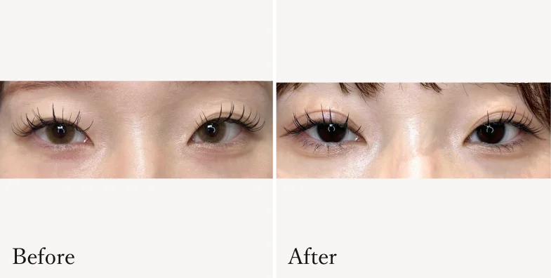 症例1 Before/After