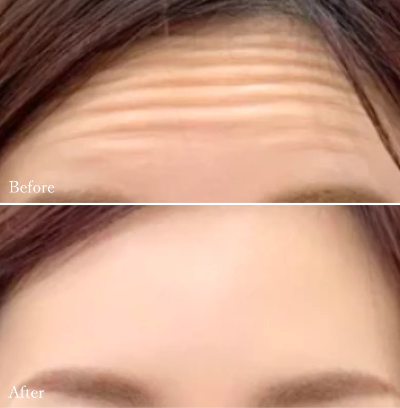 BOTOX
