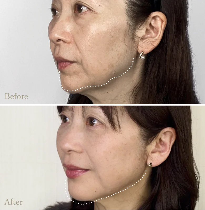 Thread Lift